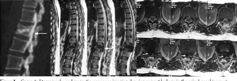 Figure From Epidural And Intradural Cement Leakage Following
