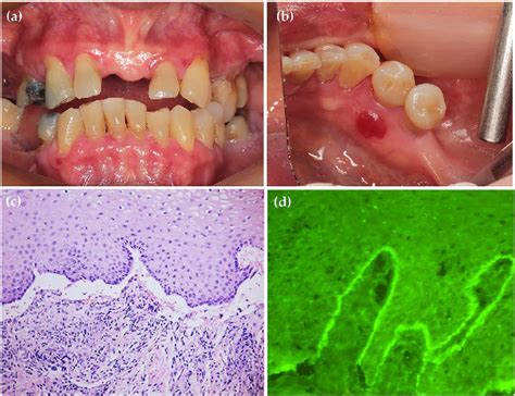 Generalized Erythematous And Erosive Areas At The Gingiva A A