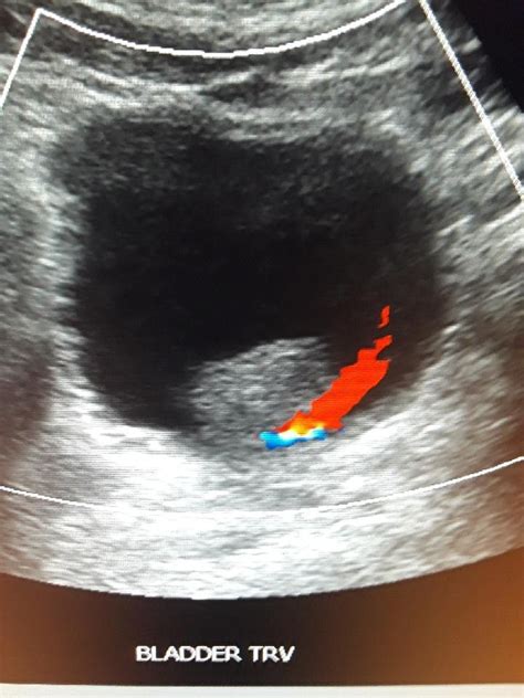 Transitional Cell Carcinoma Of The Bladder Ultrasound Medical