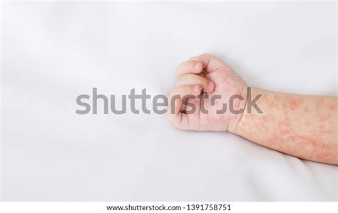 Hand Newborn Baby Measles Rash On Stock Photo 1391758751 Shutterstock