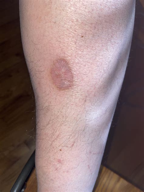 Brown Recluse Spider Bite Rash