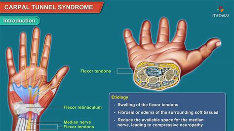Carpal Tunnel Syndrome Animation Etiology Symptoms Diagnosis My Xxx