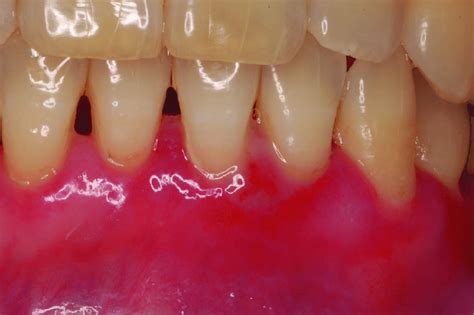 Desquamative Lesions Featuring Gingival Erythema Associated With Mucous