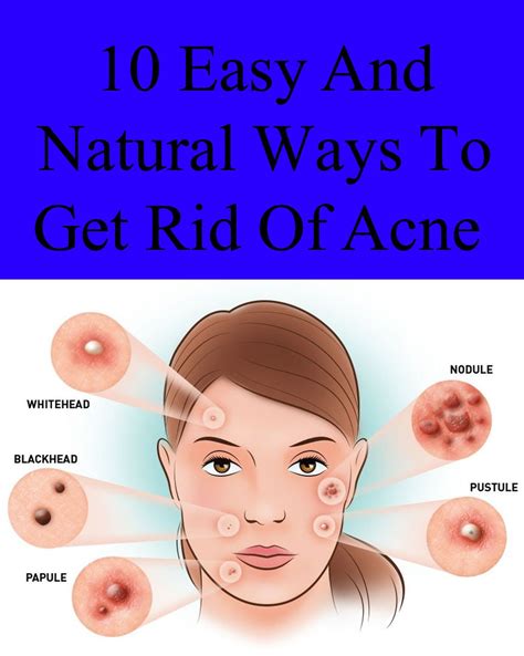 Easy And Natural Ways To Get Rid Of Acne How To Get Rid Of Acne Acne Acne Scar Removal