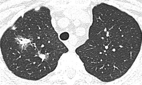 Wegeners Granulomatosis In The Chest High Resolution Ct Findings Ajr