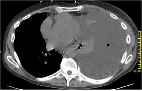 Ct Chest Massive Pleural Effusion On Left Side Arrow Open I