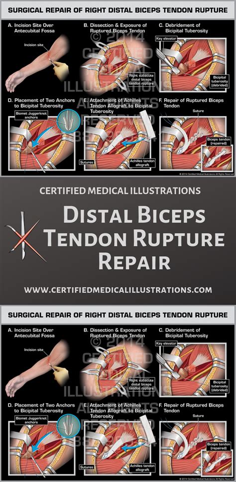Distal Biceps Tendon Rupture Is A Fairly Rare Injury That Is Most