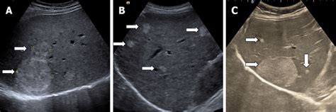 Illustration Of Multiple Hepatic Hemangioma In B Mode Ultrasound A