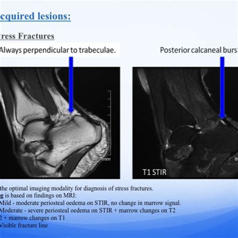 Stress Fracture Of Calcaneus References Department Of Radiology