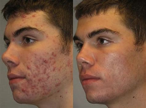 Effective Acne Treatment In Phoenix With Over 30 Years Of Expertise