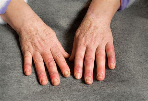 Why Are My Fingers Swollen Hand Pain Excel Ptexcel Sports Pt