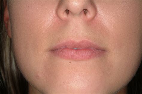 Permaliplip Enhancementlip Augmentation