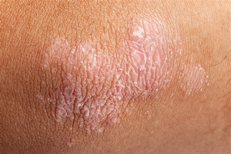 Dry Skin Xerosis Advanced Dermatology
