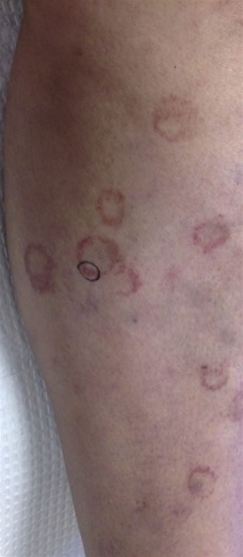 Numerous Nonblanching Annular To Arcuate Petechial Patches With Few