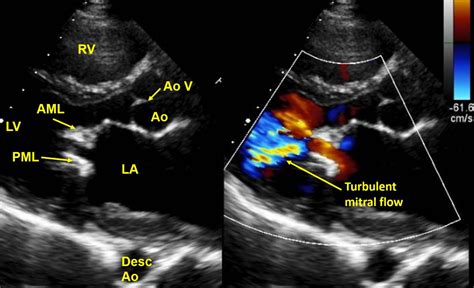 Colour Doppler Echo Quiz Discussion All About Cardiovascular