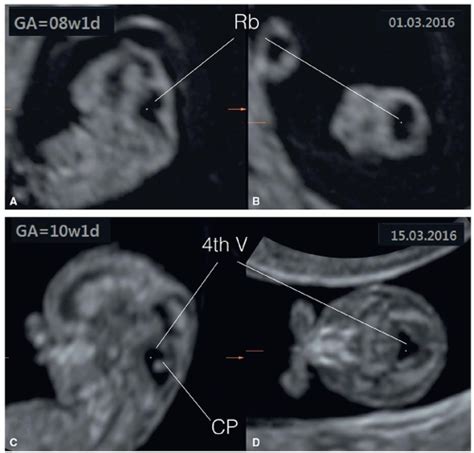 The Fetal Central Nervous System Radiology Key