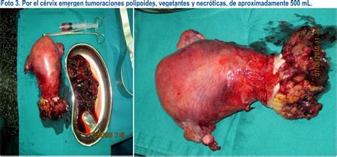 Posibles complicaciones del legrado uterino. Sarcoma del estroma endometrial de grado alto ...