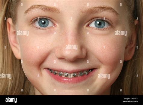 Young Girl With Dental Braces On Her Teeth Stock Photo Alamy