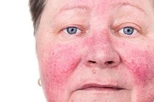 Die damit verbundene entzündung erzeugt rötungen, die sich nicht von selbst klären. Rosacea (Kupferrose / Gesichtsrose) - Ursachen, Symptome ...