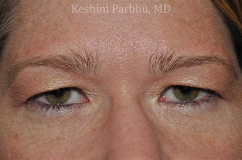 Heres What To Know About An Upper Eyelid Blepharoplasty