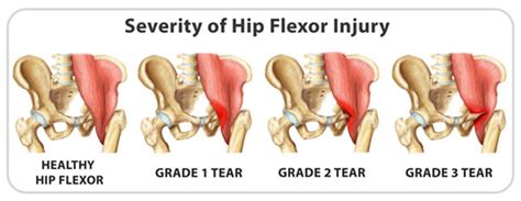 Flexors are a set of muscle tissues that physical therapy and rehab can be time consuming, and a faulty diagnosis can make treatment a total waste of time. Hip Flexor Strain: Signs, Causes, Treatment and Recovery ...