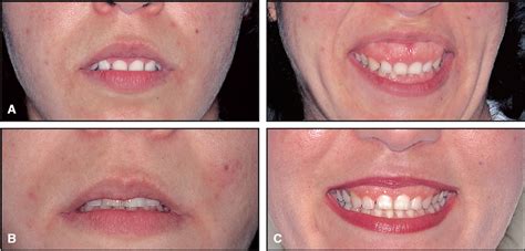 Impact Of Eight Components Of Smile On Orthodontics