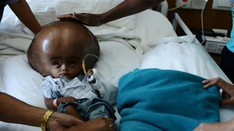 Tripura Girl Whose Head Swelled To Over Three Times Its Normal Size