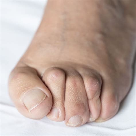 How To Treat A Toe Deformity Solon Podiatrist