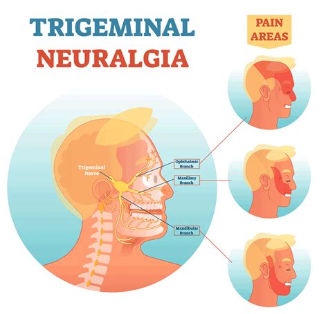 Trigeminal Neuralgia Johns Hopkins Medicine