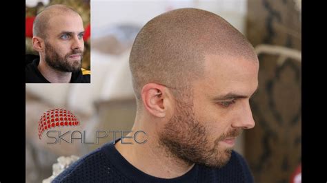 Scalp Pigmentation Results From Skalptec Amazing Outcome For Music