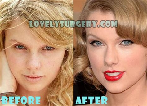 Taylor Swift Nose Job Before And After