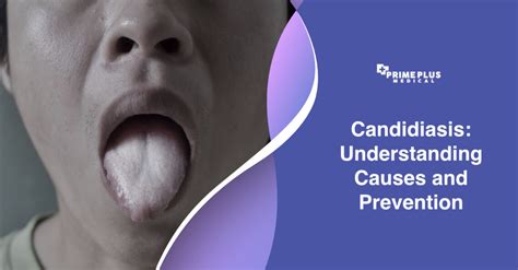 Candidiasis Understanding Causes And Prevention Prime Plus Medical