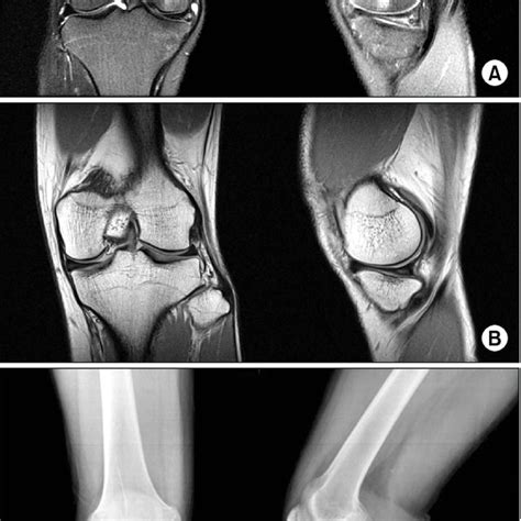 Left Knee Magnetic Resonance Imag­ Ing Showing A Complete Discoid