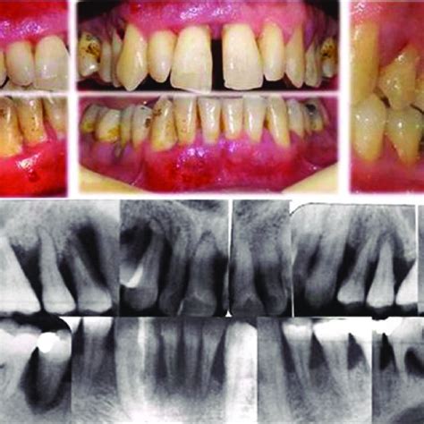 Pdf Periodontal Treatment In A Generalized Severe Chronic