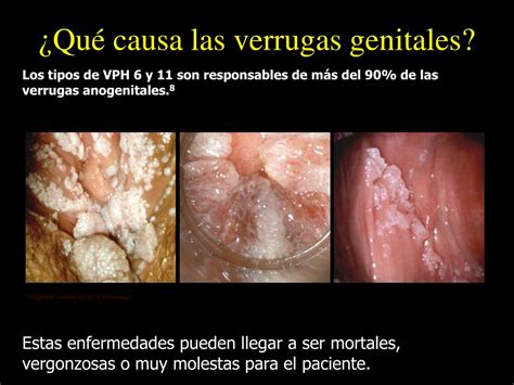 Ppt Infeccion Por Virus Del Papiloma Humano Powerpoint Presentation