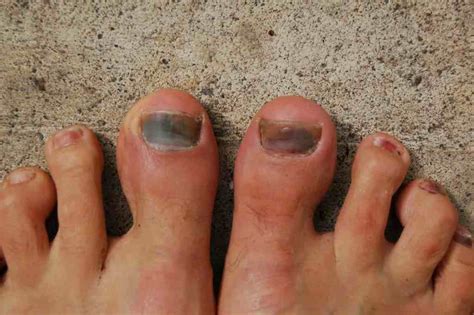 Black Toenail Cancer Things You Must Know Nedufy
