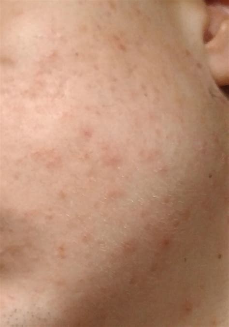 Acne Red Dots On Face Thats Not Pimples Rskincareaddiction