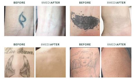 Tattoo Removal Treatment Treatment