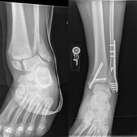 Ankle Fracture Before And After Buyxraysonline