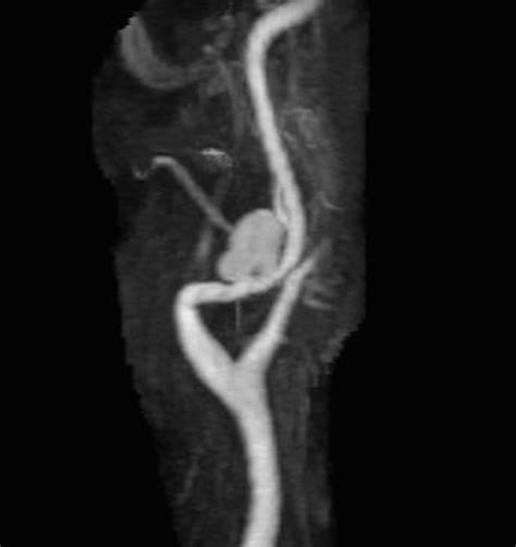Pseudoaneurysm Internal Carotid Artery Neuro Mr Case Studies