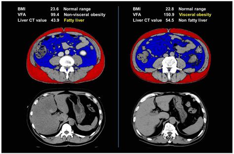 Ct Images Of Two Representative Rcc Patients In The Normal Bmi Range