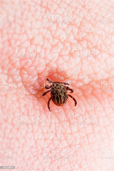 Infectious Encephalitis Tick Insect On Skin Encephalitis Virus Or Lyme