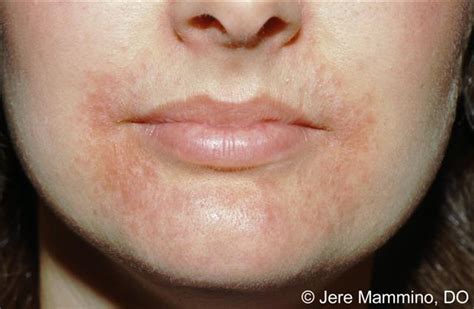 Perioral Dermatitis Pod That Frustrating Ugly Face Rash Laser
