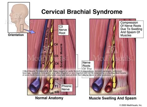 Understanding The Brachial Plexus Injury Part 1 Medivisuals Inc