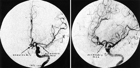 Middle Cerebral Artery Variants Diagrams Radiology Ca Vrogue Co