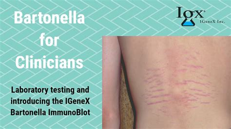 Introducing Igenex Bartonella Immunoblots Youtube