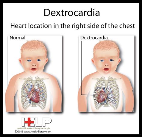Dextrocardia Heart Pinterest Situs Inversus Medical And Heart