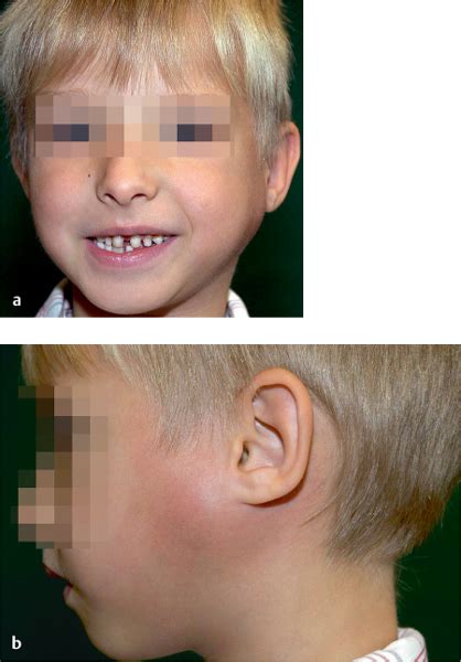 Parotid Gland Swelling And Recurrent Parotitis In A Patient With