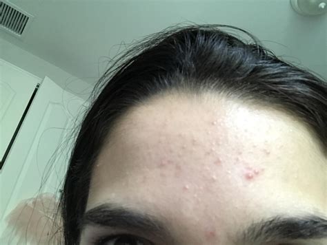 Acne Hello I Ve Had These Bumps On My Forehead For Months Now I Don T Know If This Is Fungal