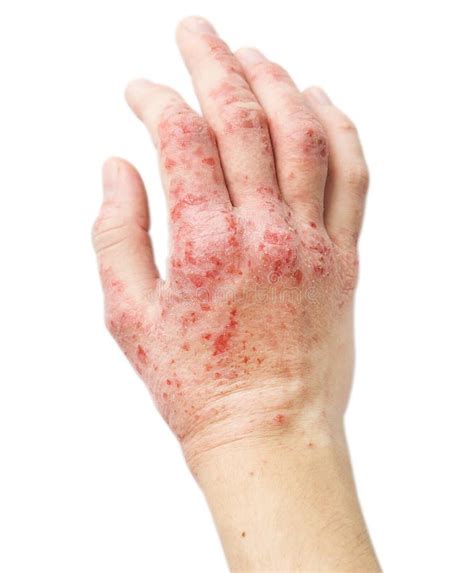 Eczema On A Female Hand Stock Image Image Of Dermatological 50561337